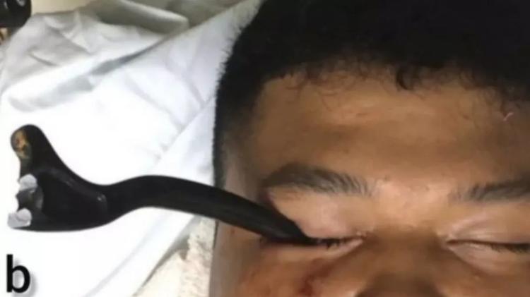 A alavanca, de 17 centímetros, ficou presa no globo ocular do paciente após o acidente