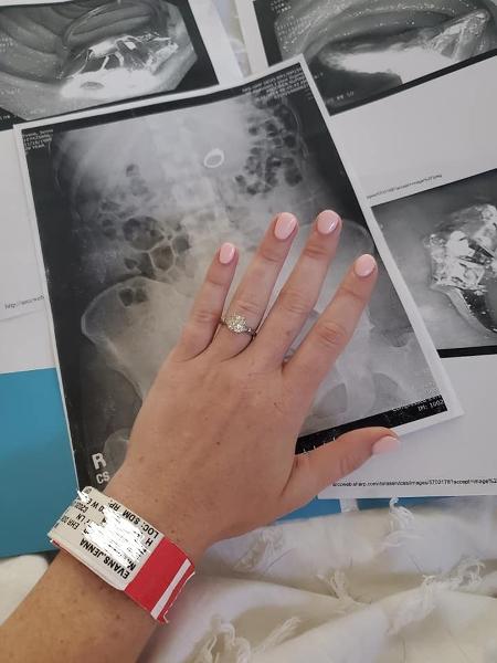 Jenna Evans mostra anel que foi engolido e exame que aponta onde a joia foi parar - Facebook