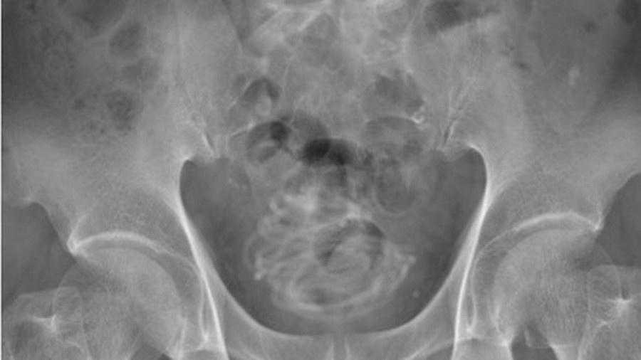 Raio-X revelou que o desconforto de paciente era provocado por uma corda presa em sua bexiga  - Divulgação/Urology Case Reports