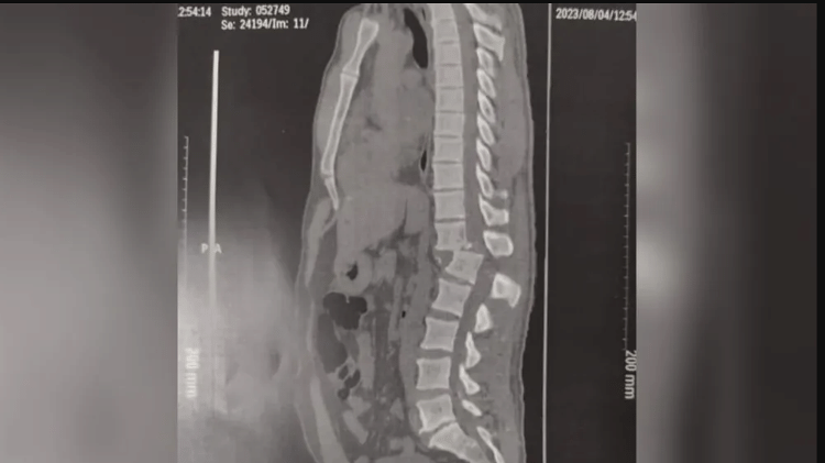 Imagem mostra lesão na coluna de homem atingido por um aparelho de musculação