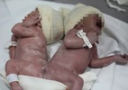Em caso raro, gêmeos siameses nascem unidos por osso da coluna no PR - Divulgação: Hospital do Rocio