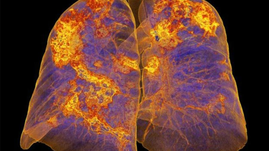 Imagem dos pulmões de uma pessoa infectada mostra áreas com pneumonia - SPL