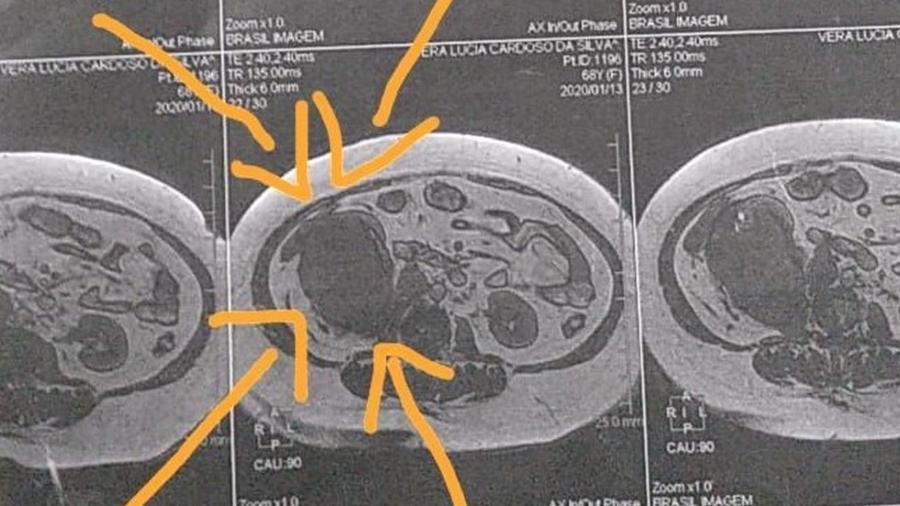 Tumor de 12 centímetros obrigou idosa a retirar um dos rins - Arquivo Pessoal