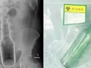 Chinês de 60 anos diz que estava se coçando quando o vidro de perfume com 18 cm foi parar dentro da cavidade anal - Divulgação/Dongguan Hospital - Divulgação/Dongguan Hospital