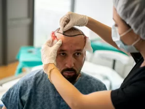 Transplante de cabelo vale a pena? O que ninguém te conta sobre os riscos