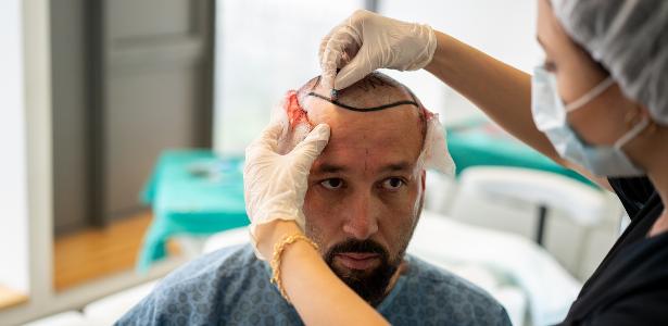 Qual a diferença entre implante e transplante capilar?