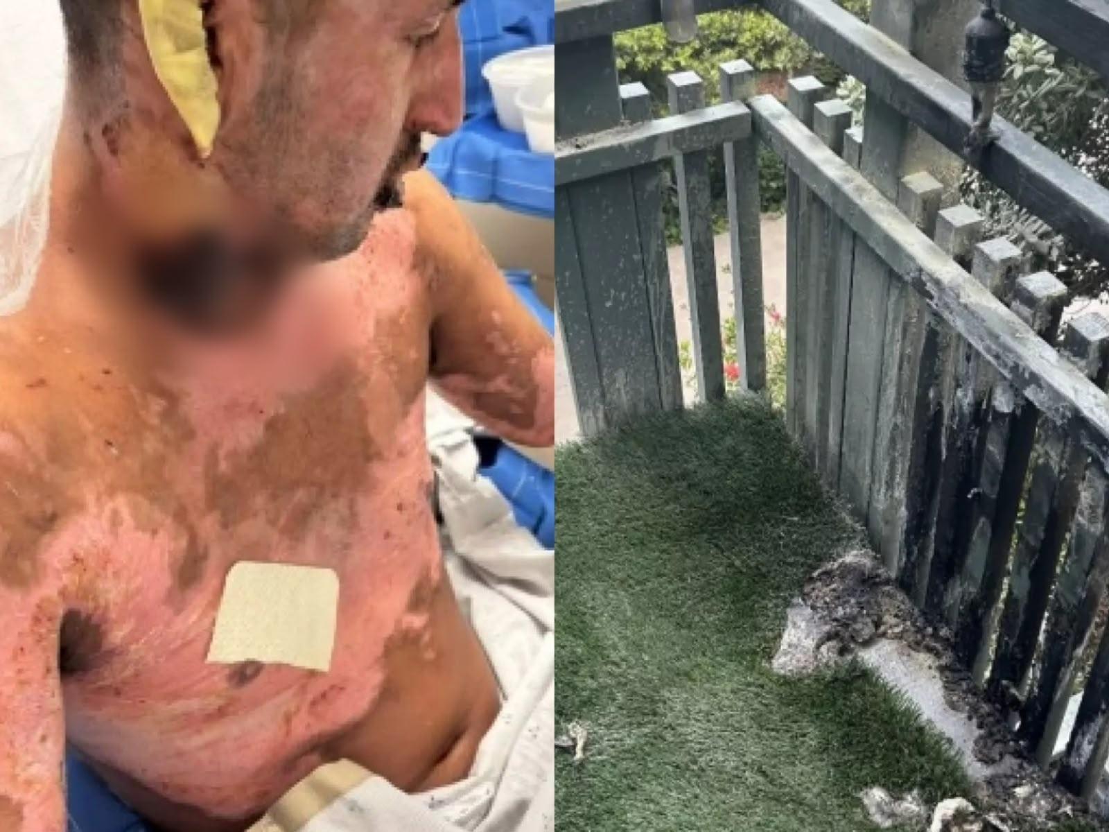 Advogados de Anthony Trevino divulgaram fotos de como o homem ficou após explosão de lareira vendida na Amazon - undefined
