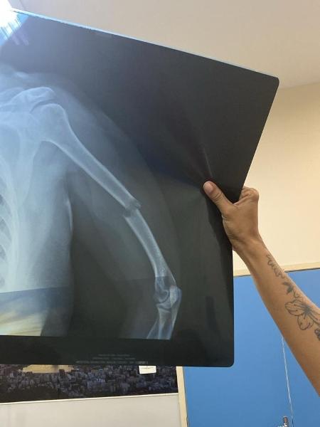 Mulher que foi operar coluna voltou de centro cirúrgico com braço quebrado