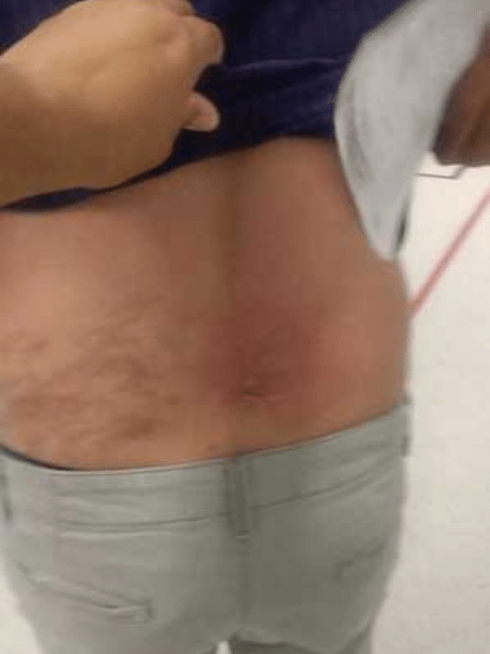 Hematoma causado por paciente em um dos funcionários de UPA; ataque começou pouco depois de médico recomendar injeção  - Divulgação/Prefeitura de Guarulhos