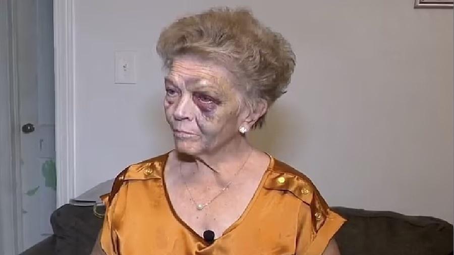 Shirlene Hernandez teve graves lesões no rosto após ser espancada por ladrão de carros.  - Reprodução