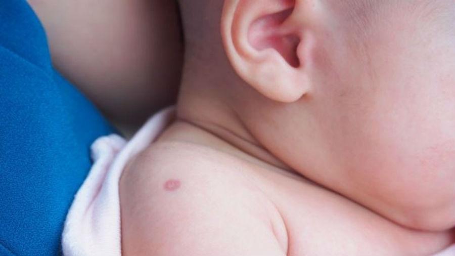 A BCG previne a tuberculose e é, junto com a imunização para hepatite B, aplicada ainda quando o bebê é recém-nascido - Getty Images