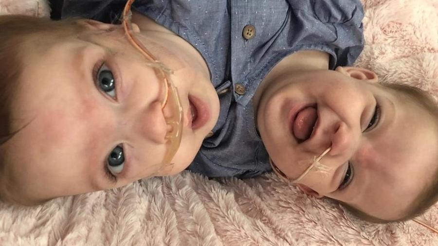 As gêmeas Sarabeth e Amelia Irwin antes da cirurgia de separação - Reprodução/GoFundMe