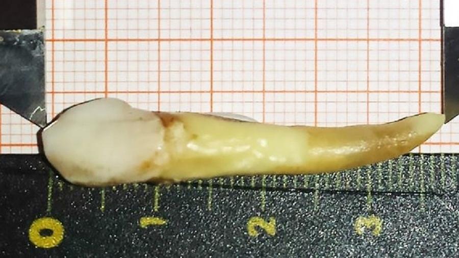 Este é, até o momento, o dente humano mais longo já registrado na história - Divulgação/Dr. Max Lukas