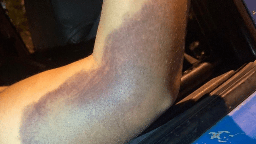 Hematoma no braço de mulher mantida em cativeiro por sogros, em Niterói (RJ) - Reprodução