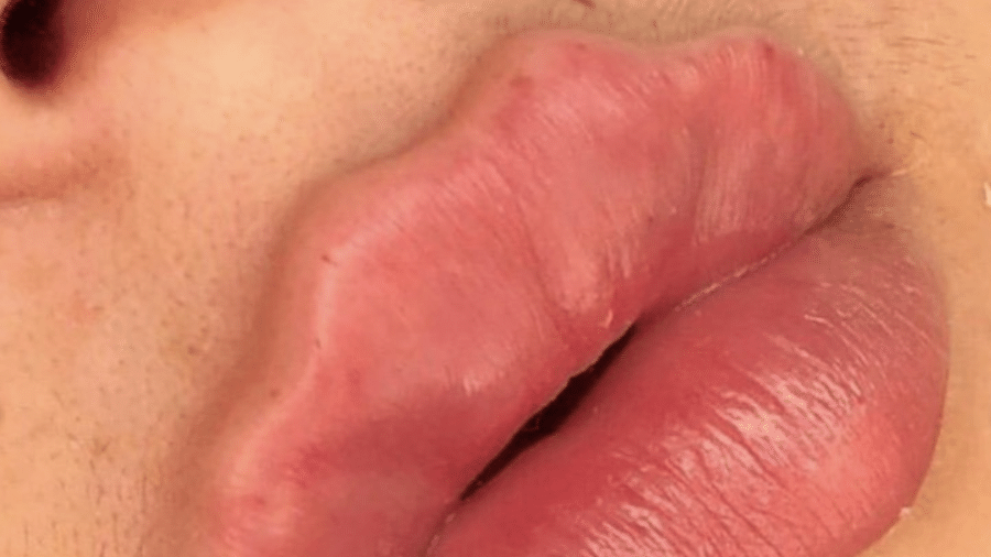 Moda de preenchimento labial chamada "devil lips", ou lábios diabólicos, teria surgido na Rússia - Reprodução