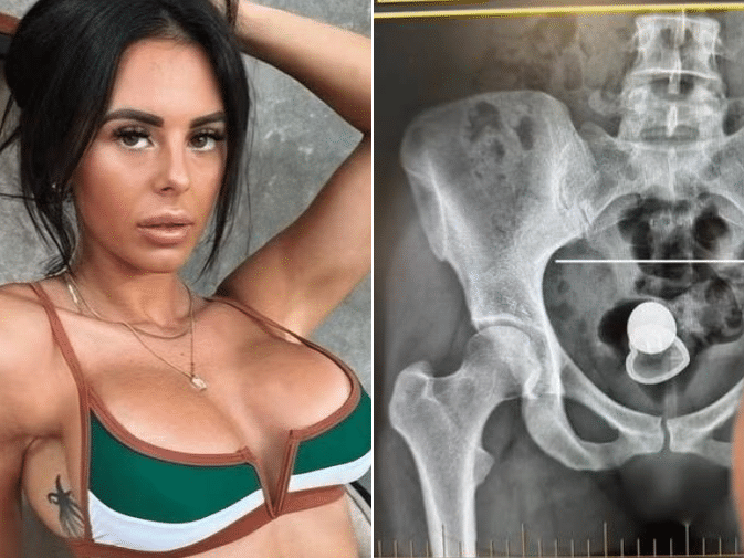 O plug anal pode 'sumir' dentro do corpo? Conhea os riscos