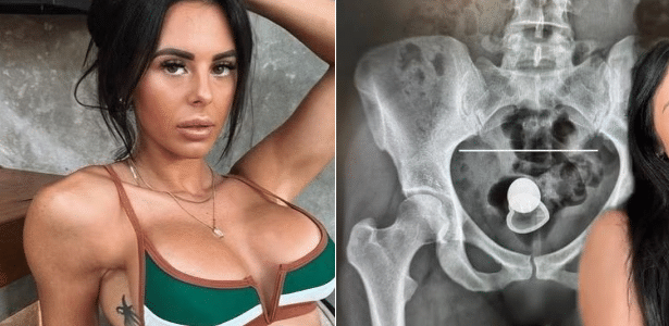 O plug anal pode 'sumir' dentro do corpo? Conhea os riscos