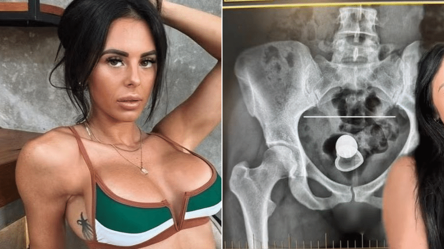 Alicia Davis teve problemas com plug anal