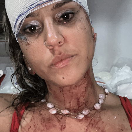 A publicitária Leila Perci disse ter levado 3 pontos na cabeça após ter sido agredida por policiais em Olinda A publicitária Leila Perci disse ter levado 3 pontos na cabeça após ter sido agredida por policiais em Olinda