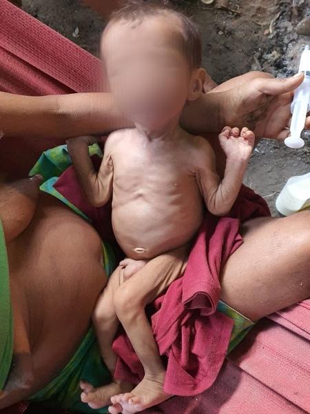 Bebê alimentado pela mãe recebe atendimento de equipe enviada pelo Ministério da Saúde à Terra Yanomami (RR) - Antonio Alvarado/@antonioalvaradoc/Urihi Associação Yanomami