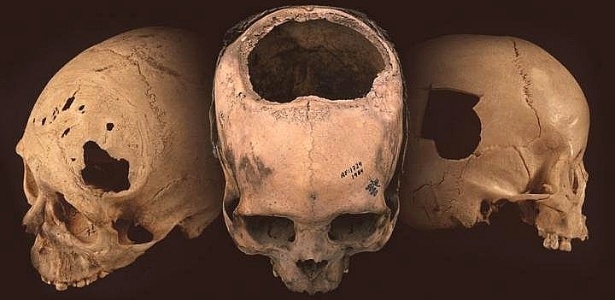 Evidências de trepanação encontrada em crânios no Peru - Universidade de Miami