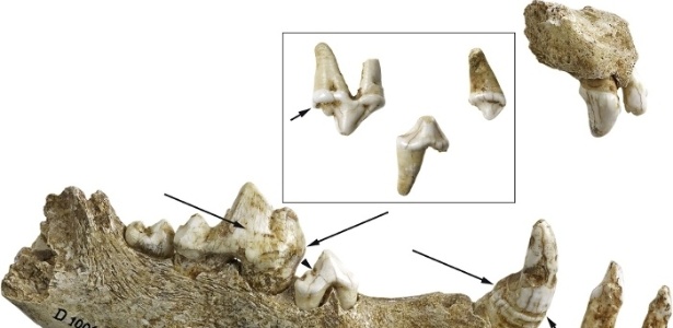 Os dentes do cachorro mais jovem da sepultura, com traços do vírus morbilli (Cinomose Canina) - LVR/LandesMuseum Bonn