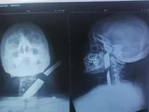 Homem é preso suspeito de cravar faca no pescoço de ex-mulher em GO