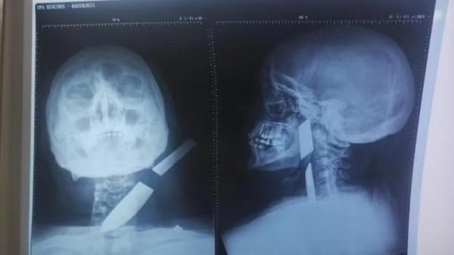 A mulher ficou com a faca cravada no pescoço após ataque - Reprodução: PMGO