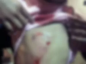 Criança fica ferida após ataque de pitbull sem focinheira no Rio