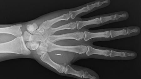 Um raio-x mostrando um implante Walletmor, que é injetado na mão de uma pessoa após um anestésico local - Divulgação/Walletmor - Divulgação/Walletmor