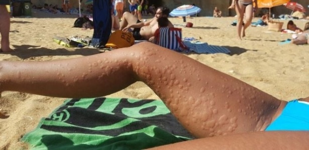No verão, a brisa fresca da praia foi suficiente para encher de urticária o corpo de Beatriz Sánchez  - Beatriz Sánchez 