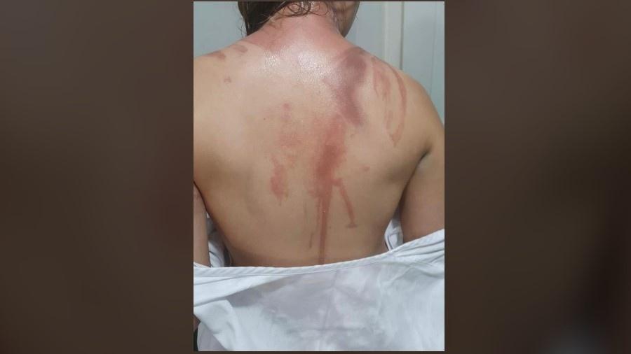 Estudante teve queimaduras durante trote na UFPR - UFPR/Divulgação