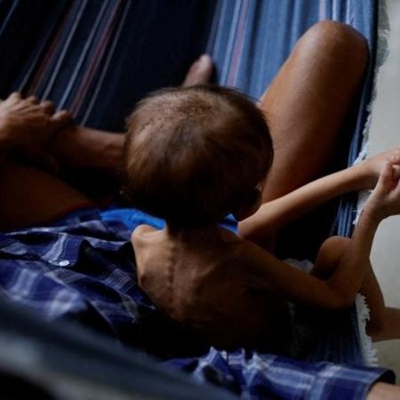 Sob Bolsonaro, mortes de yanomami por desnutrição cresceram 331%