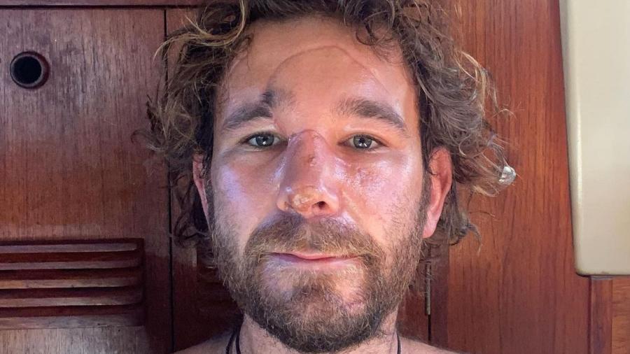 O neozelandês Danny Round, 32 anos, caiu de uma embarcação e feriu o rosto na hélice do barco  - Reprodução/syrockstar/Instagram 
