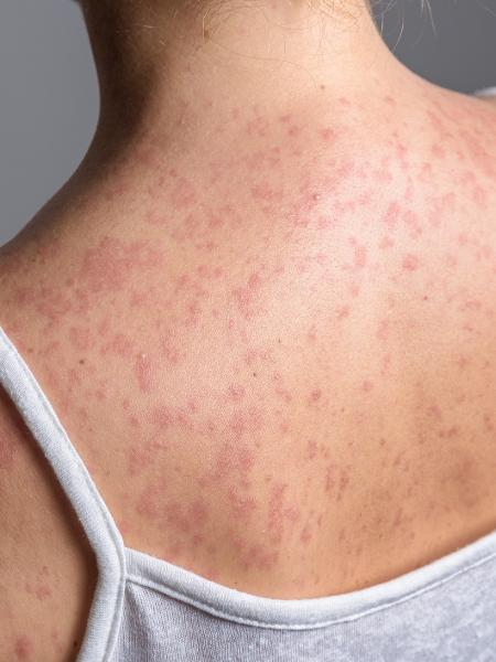 Sarampo é uma doença extremamente contagiosa, causada por um vírus