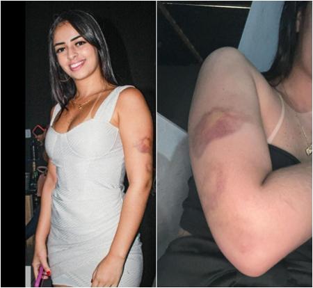 Imagens divulgadas pela polícia mostram marcas de agressão a Ielly Gabriele Alves, causadas por Diego Fonseca