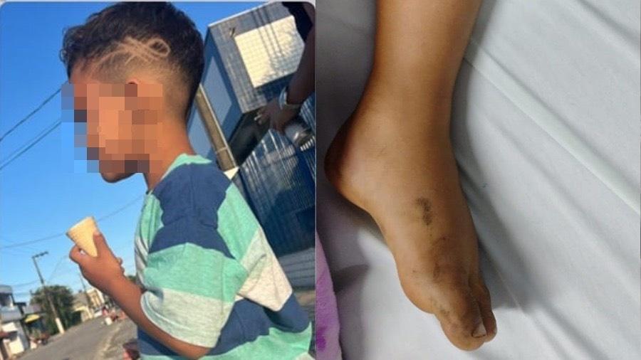João Gabriel, 6, passou por cirurgia para drenar líquido da perna, mas passa bem - Reprodução/Facebook