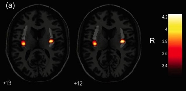 Imagens de ressonância magnética indicam variações em uma região cerebral chamada ínsula, relacionada a percepções corporais - Divulgação