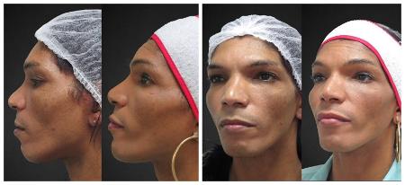 O antes e depois da harmonização facial de Kelly de Oliveira
