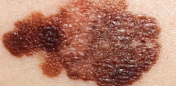 Lesão diagnosticada como melanoma; cientistas identificaram uma proteína do câncer que controla a disseminação da doença a partir da pele para outros órgãos - Wikimedia Commons
