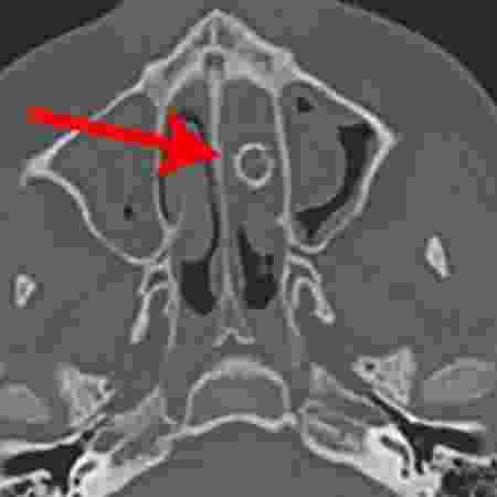  Tomografia computadorizada do nariz do adolescente mostra a bala de espingarda na cavidade nasal - Divulgação/JAMA Otolaryngology - Divulgação/JAMA Otolaryngology