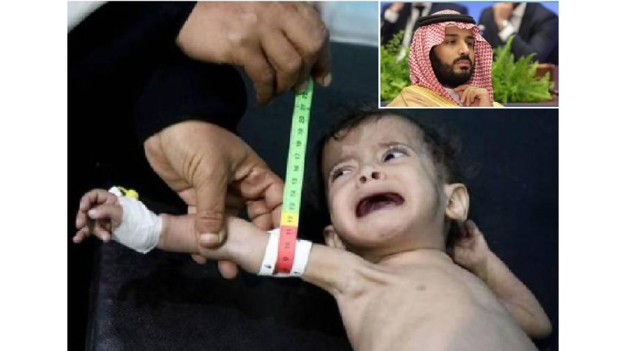 Criança do Iêmen vítima dos ataques indiscriminados a civis comandados por Mohammed bin Salman (destaque), ministro da Defesa da Arábia Saudita e seu governante de fato. É o "nosso" (deles) infanticida - Reprodução