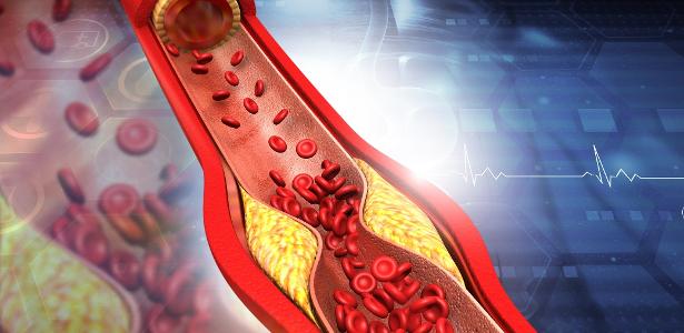 Understanding High Cholesterol: Risks, Prevention, and Heart Health - News Directory 3