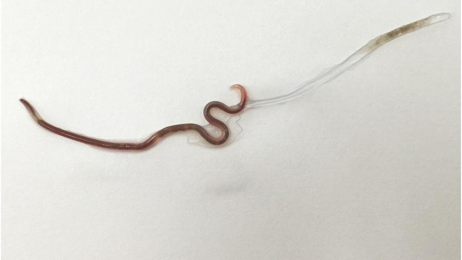 Verme parasita tinha quatro centímetros de comprimento e ainda estava vivo quando retirado - Divulgação/The American Society of Tropical Medicine and Hygiene