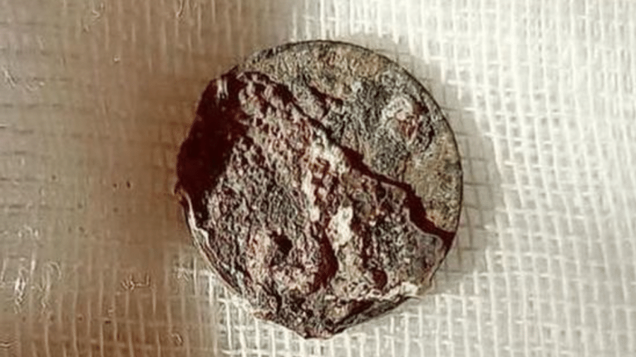 Moeda com o valor de 1 copeque foi encontrada "fossilizada", após passar 53 anos no organismo do paciente - Reprodução/Twitter/@mkomsomolets