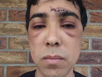 Brasileiro agredido na Irlanda diz temer sair na rua: 'Ele segue solto'