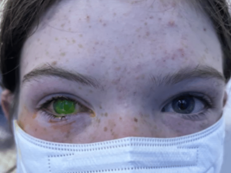 Jovem mulher com doença de Hordéolo no olho, Banco de Video