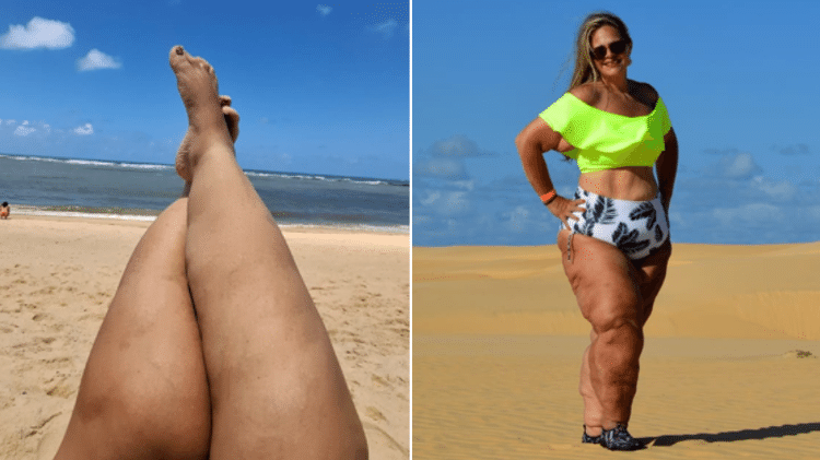 Luciane relata que o diagnóstico de lipedema foi fundamental para que passasse a aceitar o próprio corpo Luciane relata que o diagnóstico de lipedema foi fundamental para que passasse a aceitar o próprio corpo