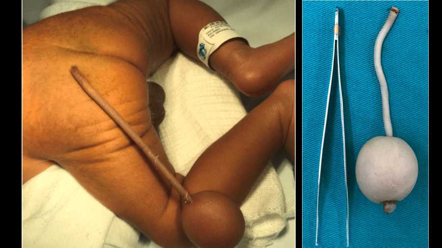 Bebê prematuro nasceu com um apêndice de 12 centímetros que tinha uma bola na extremidade. Caso aconteceu em Fortaleza  - Journal of Pediatric Surgery Case Reports