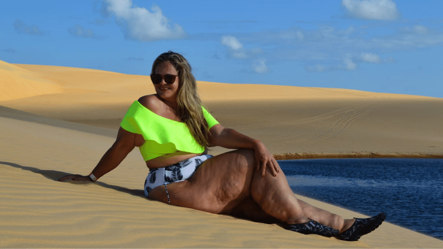 Luciane notou que, mesmo após a bariátrica, suas pernas seguiam volumosas Luciane notou que, mesmo após a bariátrica, suas pernas seguiam volumosas